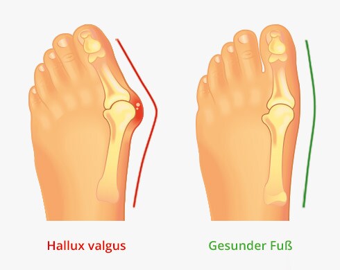Hallux Valgus Hallux Valgus