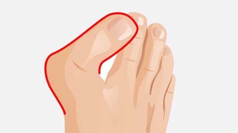4. Stadium: Hallux valgus-Winkel um 90° 4. Stadium: Hallux valgus-Winkel um 90°