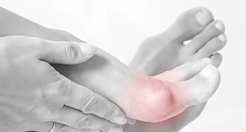 Gut zu Fuß trotz Hallux valgus Gut zu Fuß trotz Hallux valgus