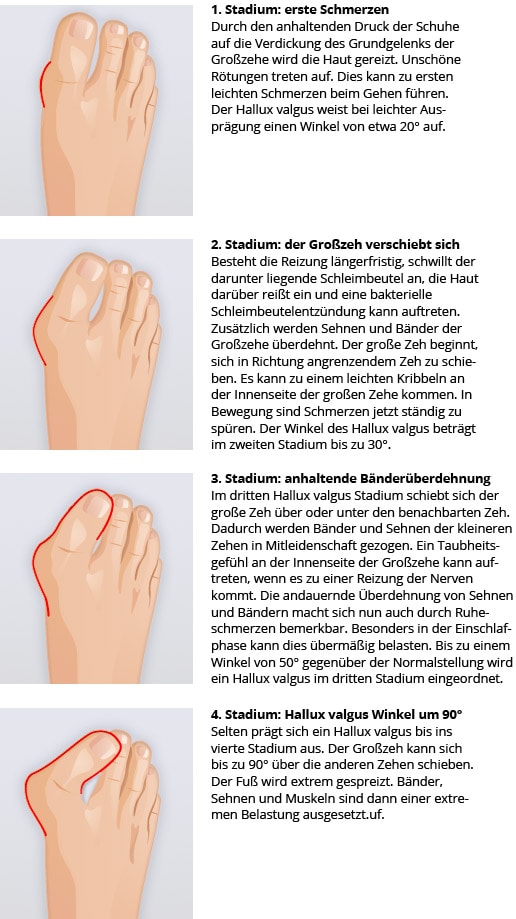 hallux valgus die besten übungen zur selbsthilfe