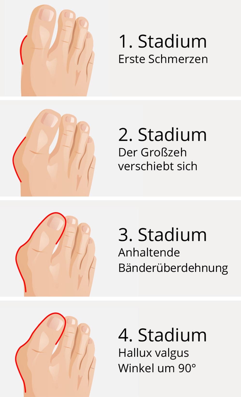Entwicklung HalluxValgus | Avena Entwicklung HalluxValgus | Avena